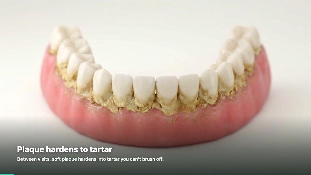 Dental Cleaning — 3D patient education video
