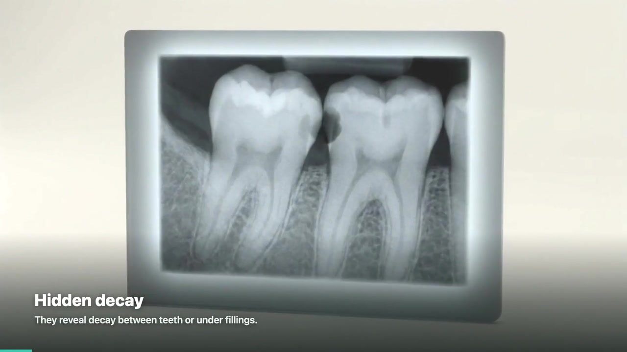 Dental X-Rays — 3D patient education video