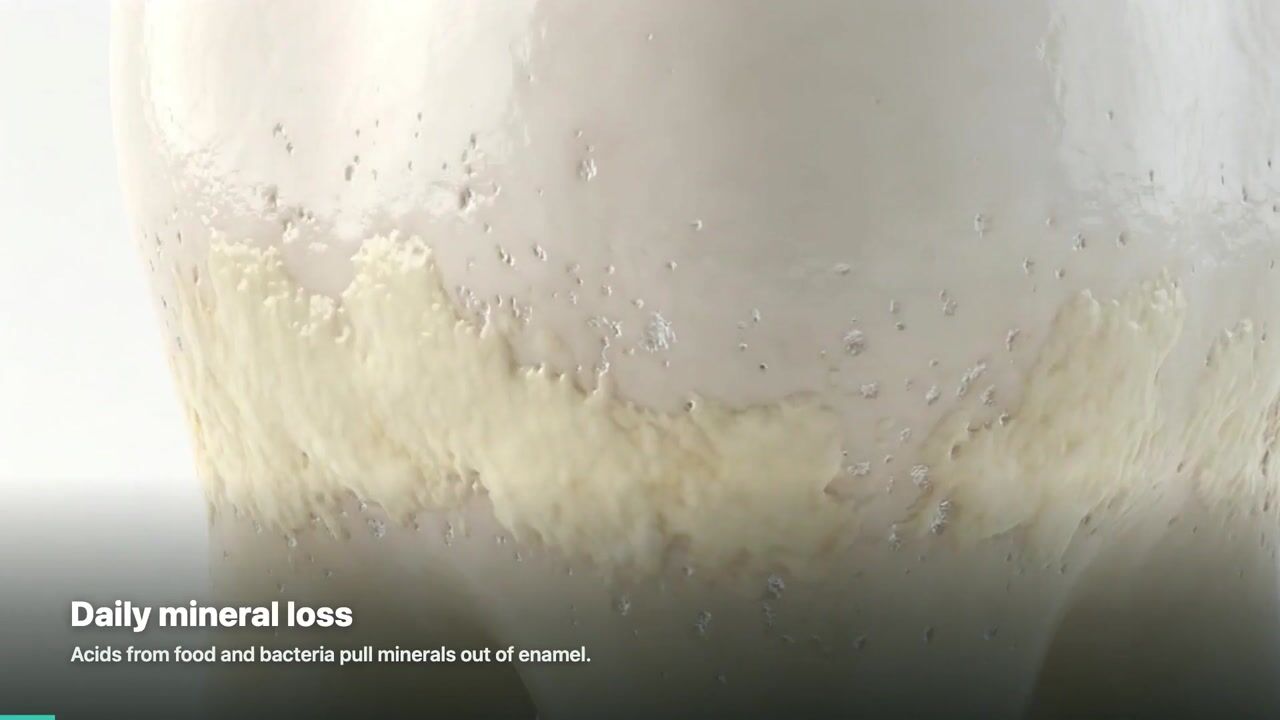 Fluoride Treatment — 3D patient education video