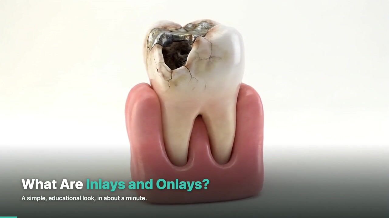 Inlays & Onlays — 3D patient education video
