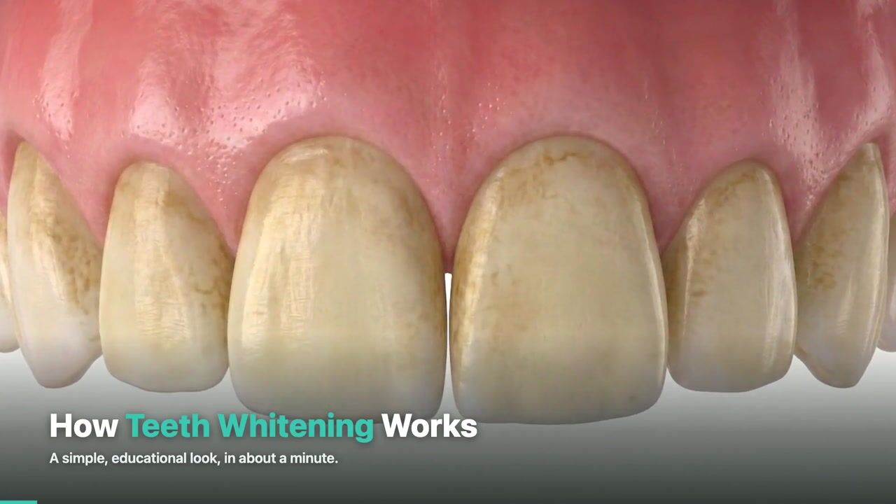 Teeth Whitening — 3D patient education video