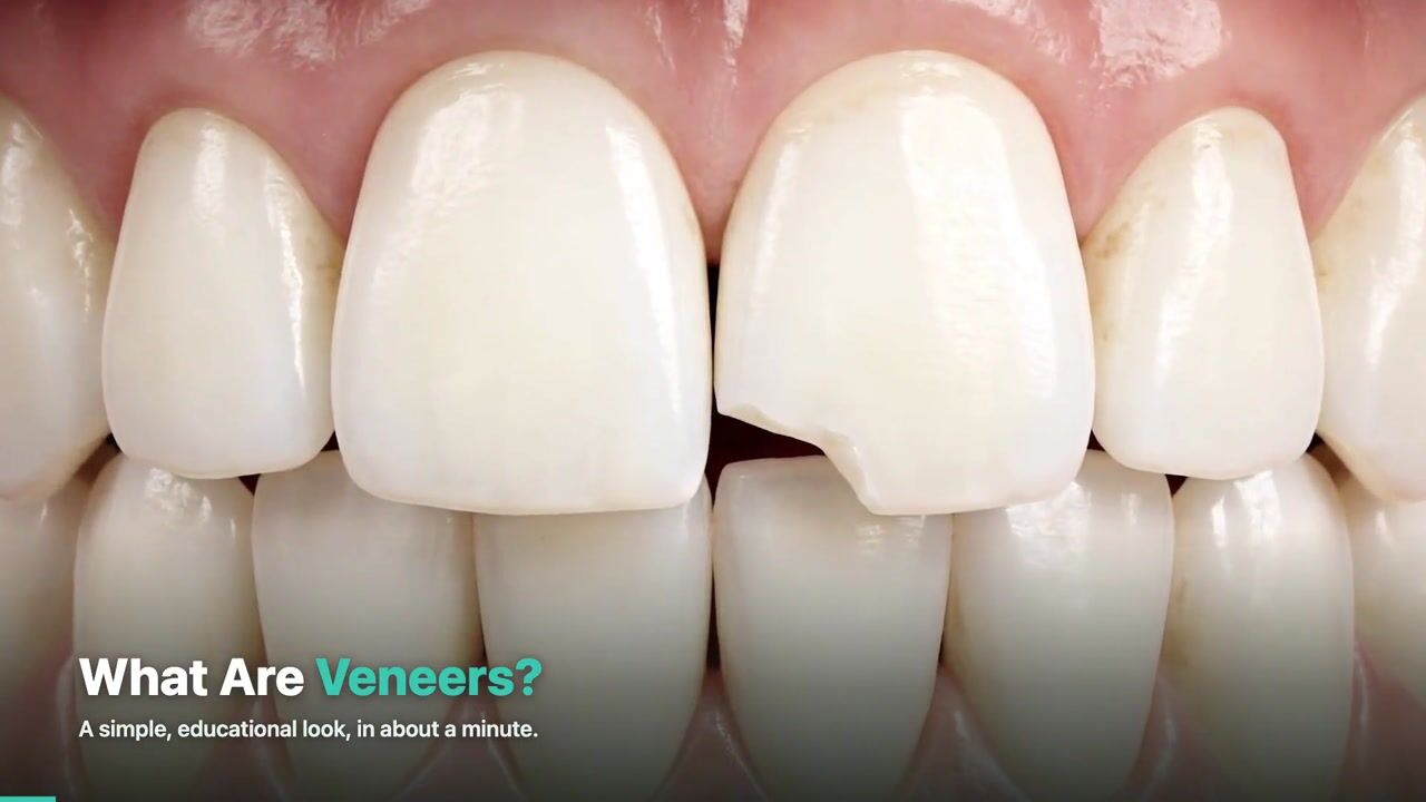 Veneers — 3D patient education video